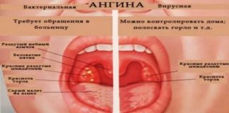 Хронический тонзиллит у детей: лечение