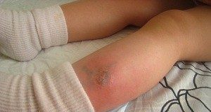 Признаки и симптомы аллергии на укусы комаров у детей: лечение и правила оказания помощи при отеке Квинке