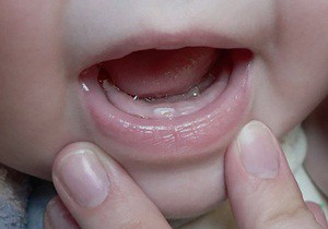 прорезывание зубов у детей фото