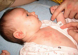 как проявляется аллергия у новорожденных