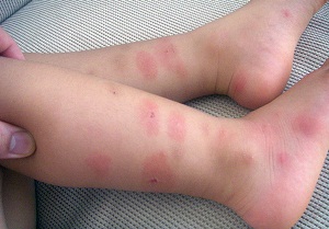 укусы комаров у детей фото