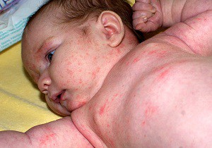аллергия у новорожденных на лице фото