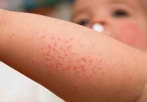 аллергический дерматит комаровский