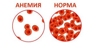 Анемия у грудного ребенка