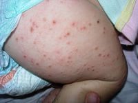 аллергическая сыпь у детей