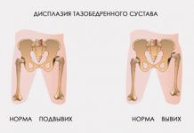 Признаки дисплазии тазобедренных суставов у грудничков