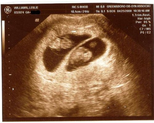 Многоплодная беременность: признаки на ранних сроках.jpg