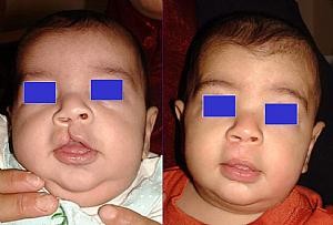«Заячья губа» у новорожденных до и после операции.jpg