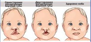 «Заячья губа» у новорожденных виды патологии.jpg