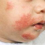 allergicheskij-dermatit