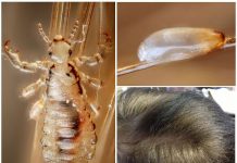 Чем опасен педикулез во время беременности