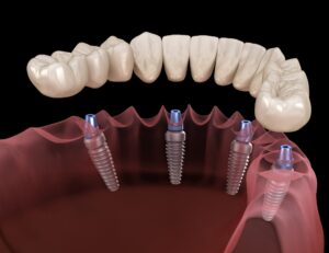 Все что нужно знать об имплантации зубов